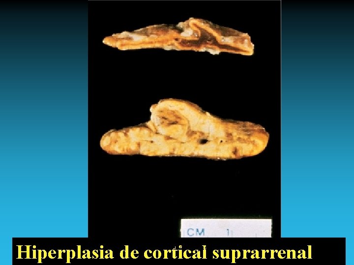 Hiperplasia de cortical suprarrenal Antonio Ferrández Izquierdo 