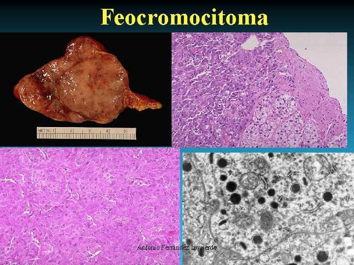 Feocromocitoma Antonio Ferrández Izquierdo 