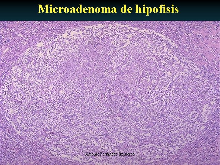 Microadenoma de hipofisis Antonio Ferrández Izquierdo 