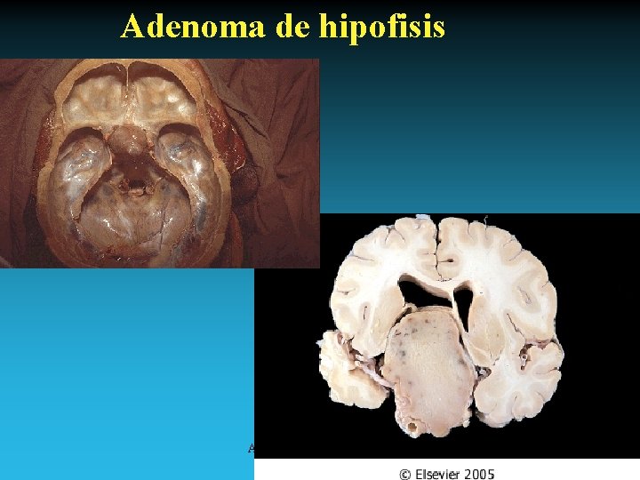 Adenoma de hipofisis Antonio Ferrández Izquierdo 