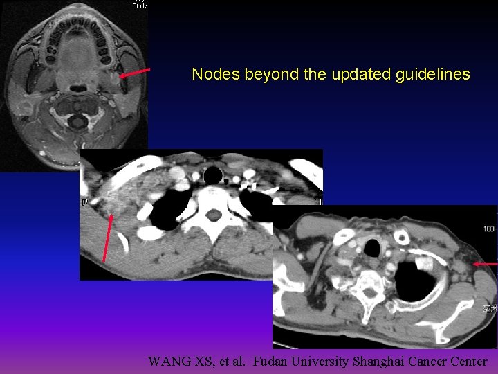 Nodes beyond the updated guidelines WANG XS, et al. Fudan University Shanghai Cancer Center