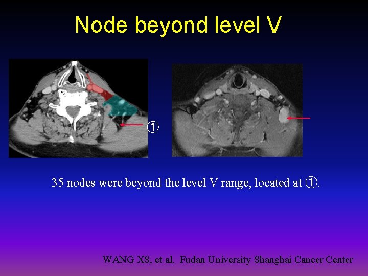 Node beyond level V ① 35 nodes were beyond the level V range, located