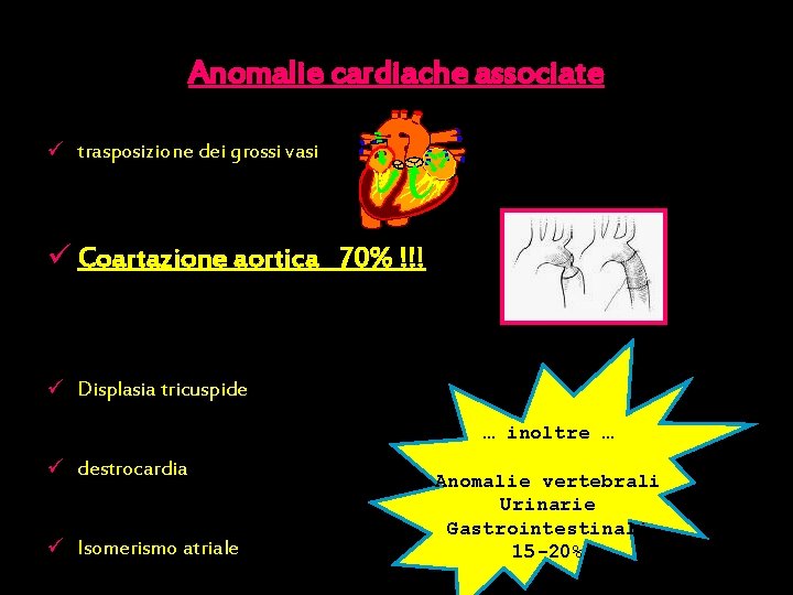 Anomalie cardiache associate ü trasposizione dei grossi vasi ü Coartazione aortica 70% !!! ü