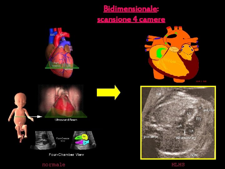 Bidimensionale: scansione 4 camere normale HLHS 