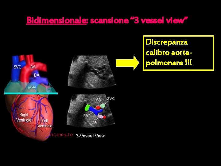 Bidimensionale: scansione “ 3 vessel view” Discrepanza calibro aortapolmonare !!! normale 