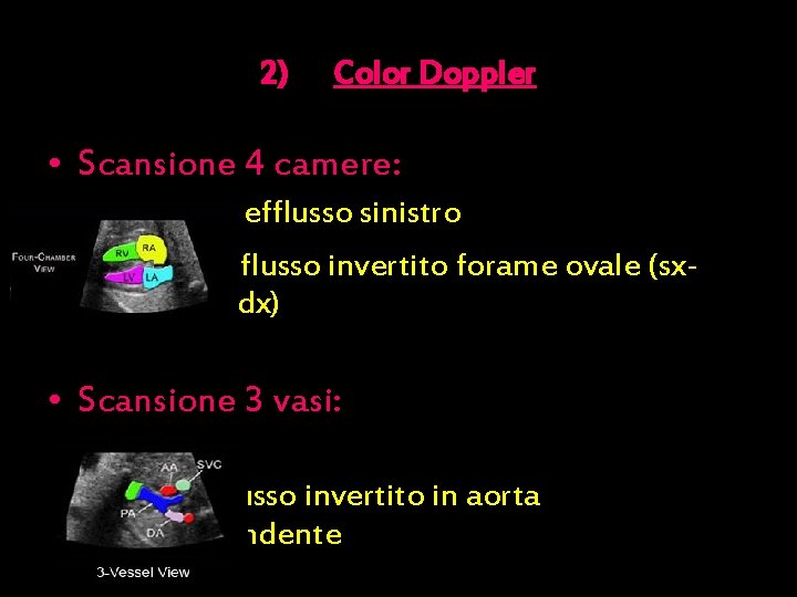 2) Color Doppler • Scansione 4 camere: efflusso sinistro flusso invertito forame ovale (sxdx)