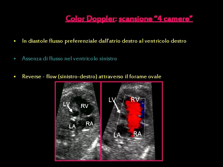 Color Doppler: scansione “ 4 camere” • In diastole flusso preferenziale dall’atrio destro al