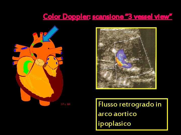 Color Doppler: scansione “ 3 vessel view” Flusso retrogrado in arco aortico ipoplasico 