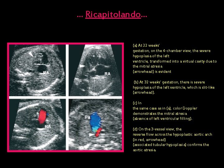 … Ricapitolando… (a) At 22 weeks’ gestation, on the 4 -chamber view, the severe