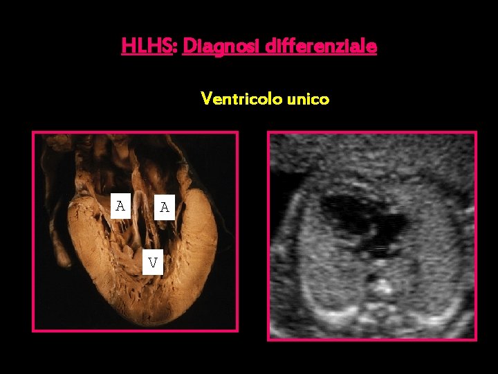 HLHS: Diagnosi differenziale Ventricolo unico v A AA V 