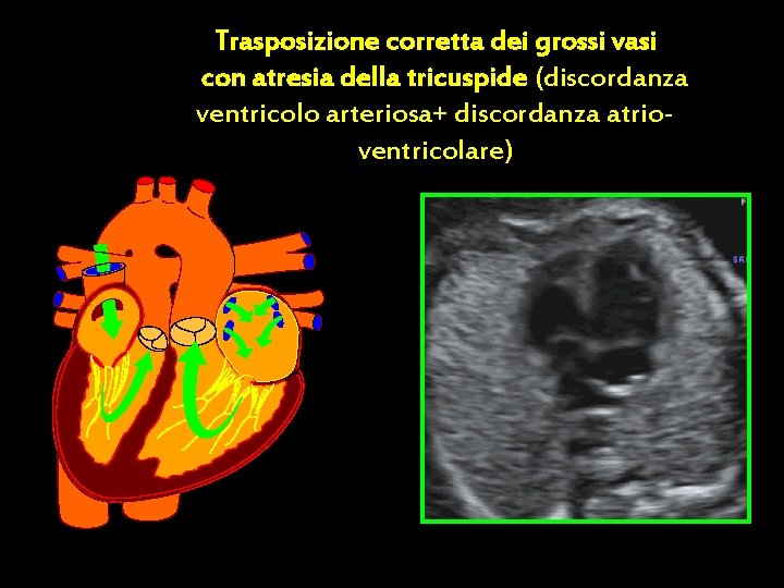 Trasposizione corretta dei grossi vasi con atresia della tricuspide (discordanza ventricolo arteriosa+ discordanza atrioventricolare)