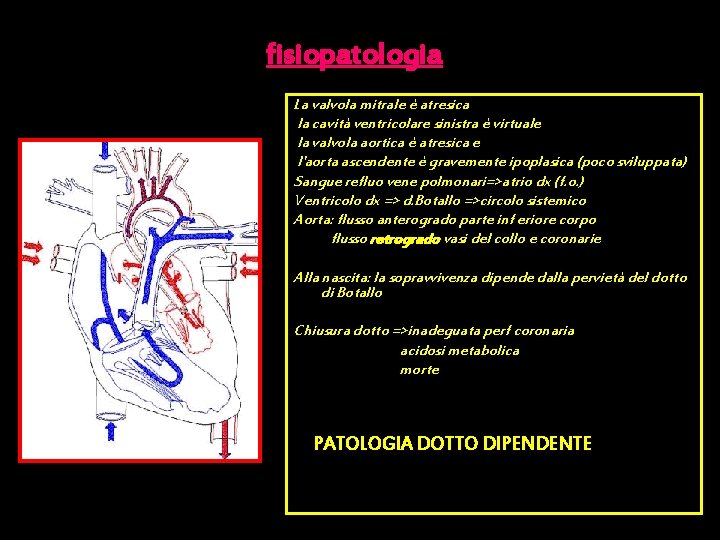 fisiopatologia La valvola mitrale è atresica la cavità ventricolare sinistra è virtuale la valvola