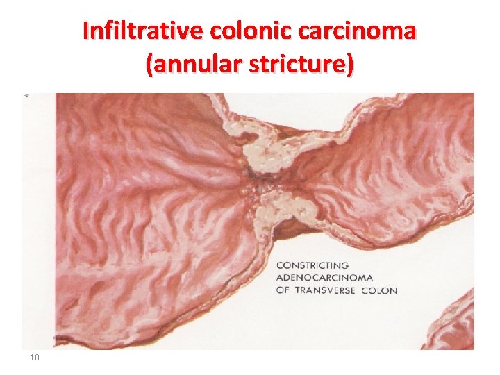 Infiltrative colonic carcinoma (annular stricture) 10 