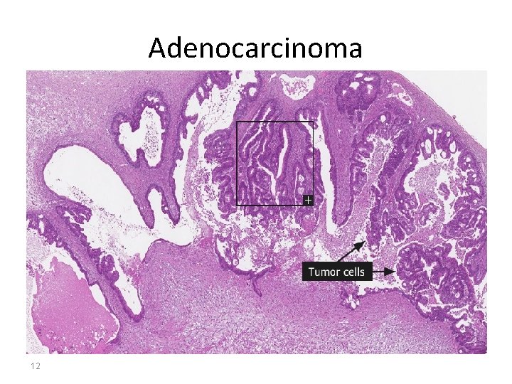 Adenocarcinoma 12 