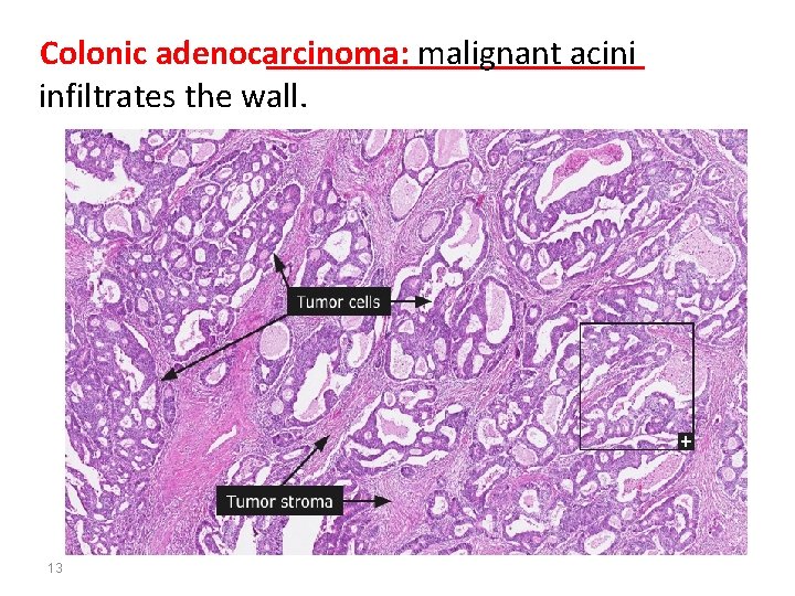 Colonic adenocarcinoma: malignant acini infiltrates the wall. 13 