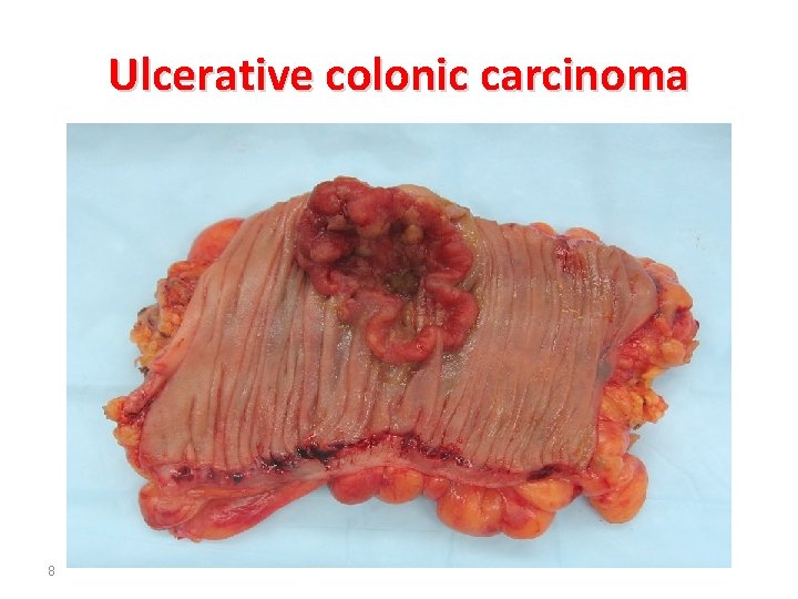 Ulcerative colonic carcinoma 8 