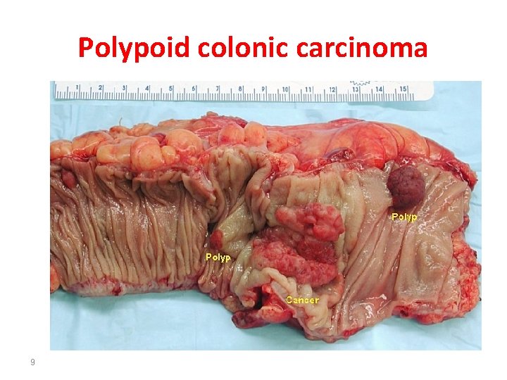 Polypoid colonic carcinoma 9 