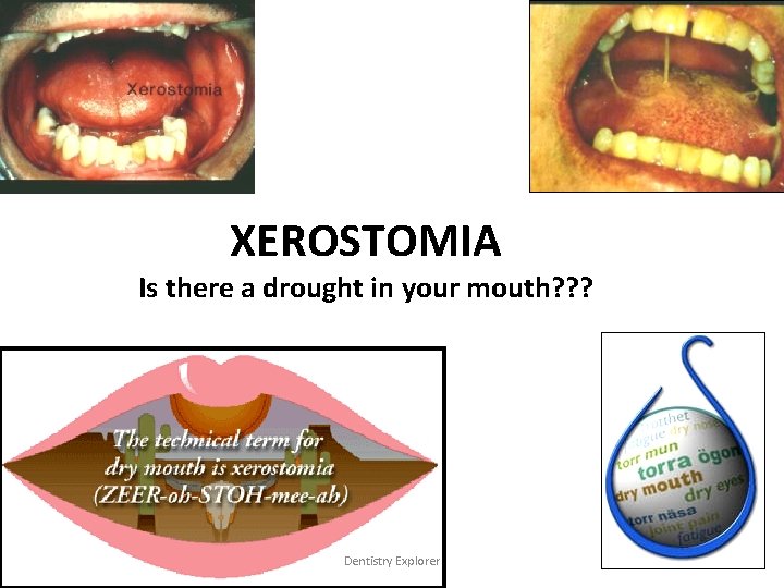 XEROSTOMIA Is there a drought in your mouth? ? ? Dentistry Explorer 