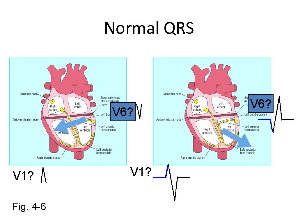 Normal QRS V 6? V 1? Fig. 4 -6 V 1? V 6? 