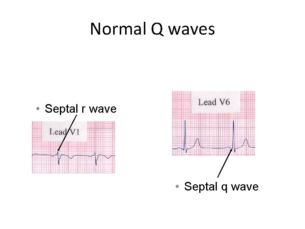 Normal Q waves • Septal r wave • Septal q wave 