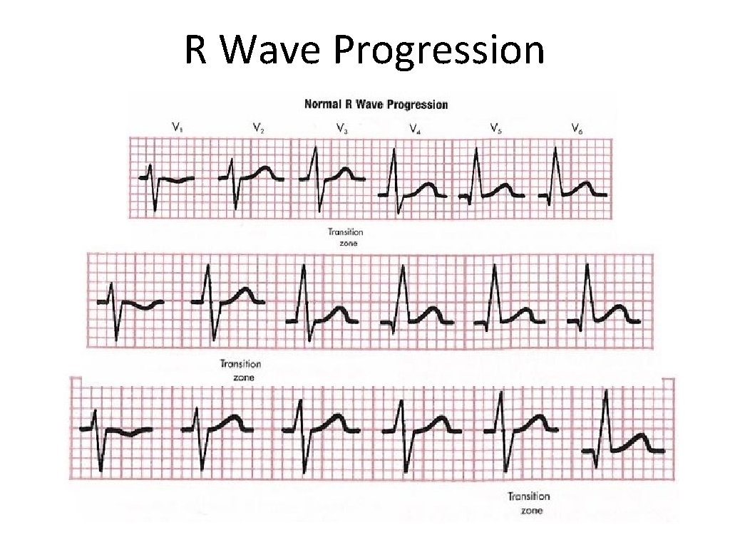 R Wave Progression 