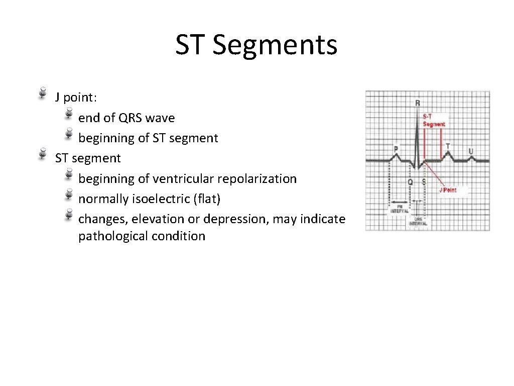 ST Segments J point: end of QRS wave beginning of ST segment beginning of