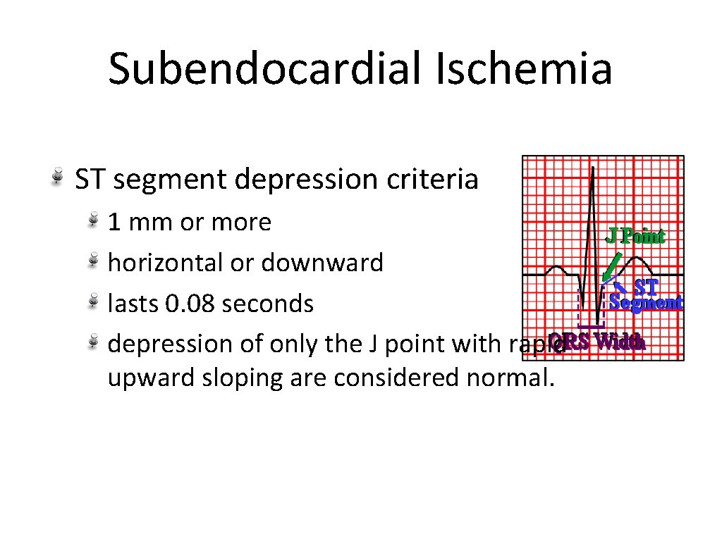Subendocardial Ischemia ST segment depression criteria 1 mm or more horizontal or downward lasts