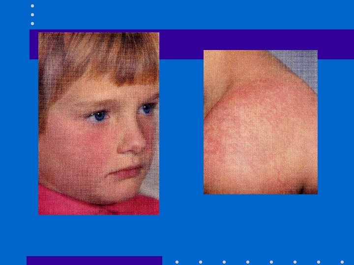 Eruptions Cutanes D Origine Infectieuse 2 Cours De