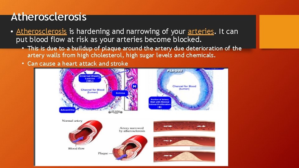 Atherosclerosis • Atherosclerosis is hardening and narrowing of your arteries. It can put blood