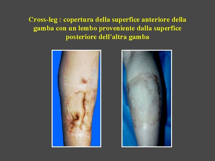 Cross-leg : copertura della superfice anteriore della gamba con un lembo proveniente dalla superfice