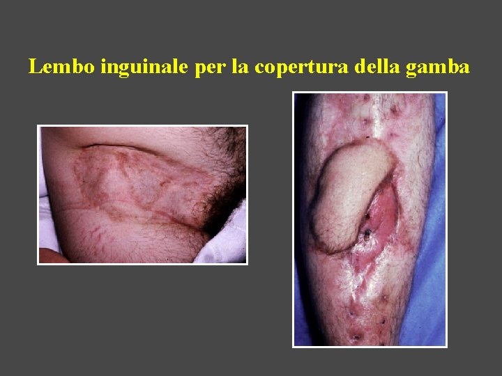 Lembo inguinale per la copertura della gamba 
