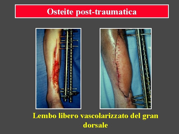Osteite post-traumatica Lembo libero vascolarizzato del gran dorsale 