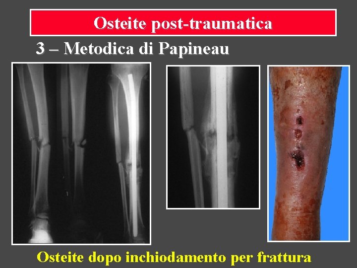 Osteite post-traumatica 3 – Metodica di Papineau Osteite dopo inchiodamento per frattura 