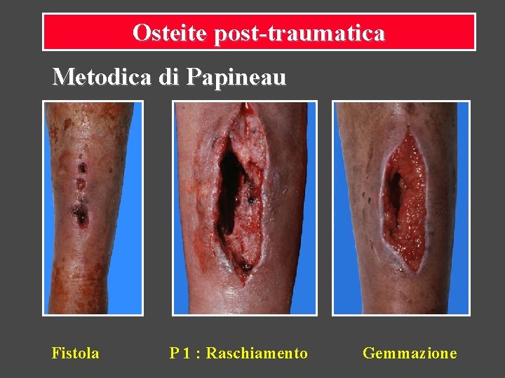 Osteite post-traumatica Metodica di Papineau Fistola P 1 : Raschiamento Gemmazione 