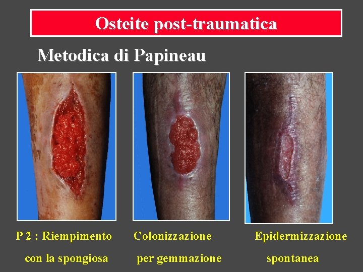Osteite post-traumatica Metodica di Papineau P 2 : Riempimento con la spongiosa Colonizzazione per