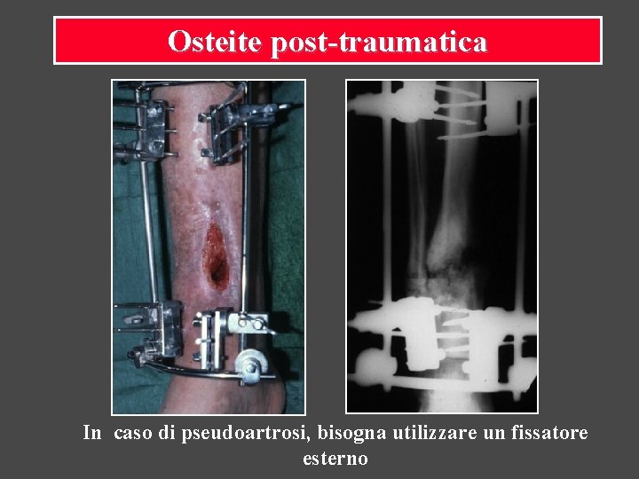 Osteite post-traumatica In caso di pseudoartrosi, bisogna utilizzare un fissatore esterno 
