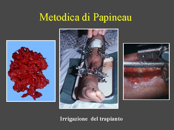 Metodica di Papineau Irrigazione del trapianto 
