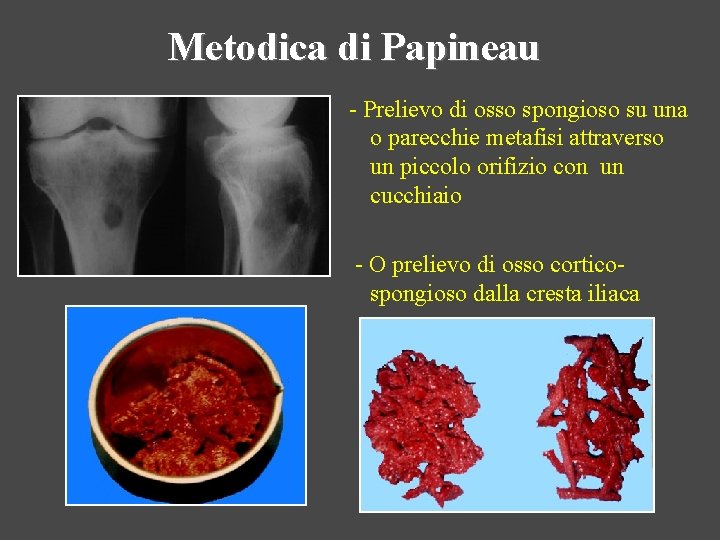 Metodica di Papineau - Prelievo di osso spongioso su una o parecchie metafisi attraverso