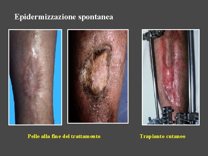 Epidermizzazione spontanea Pelle alla fine del trattamento Trapianto cutaneo 