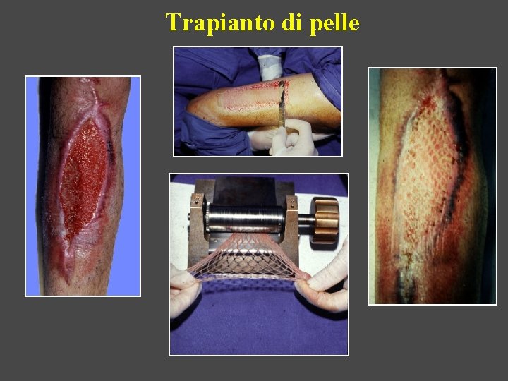 Trapianto di pelle 