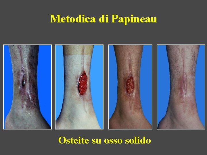 Metodica di Papineau Osteite su osso solido 