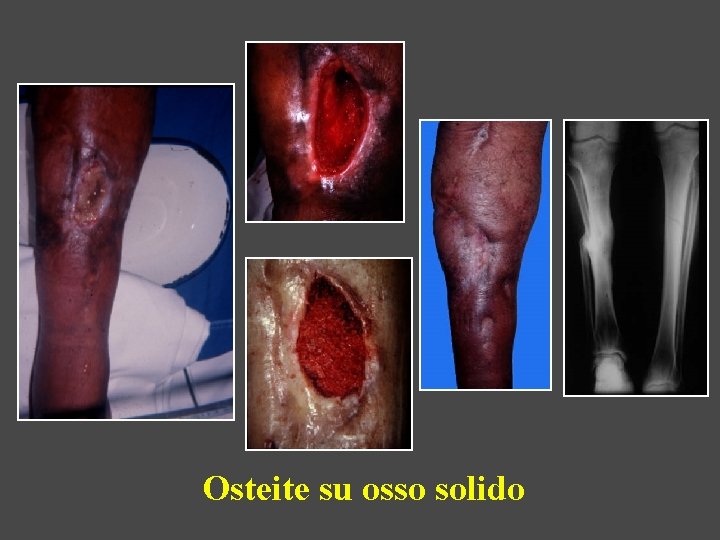 Osteite su osso solido 