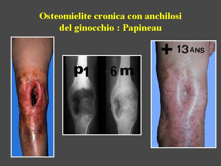 Osteomielite cronica con anchilosi del ginocchio : Papineau 