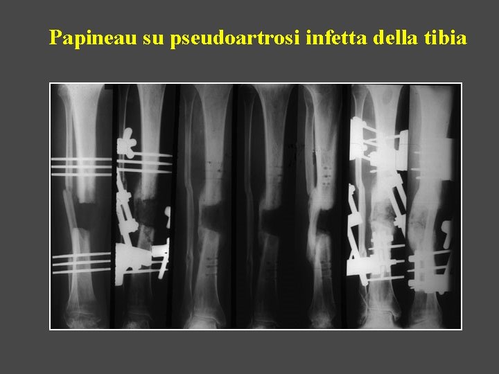 Papineau su pseudoartrosi infetta della tibia 