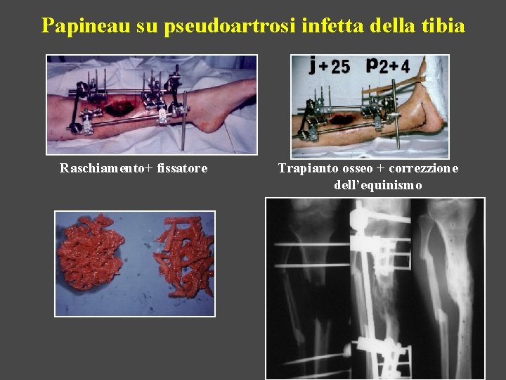 Papineau su pseudoartrosi infetta della tibia Raschiamento+ fissatore Trapianto osseo + correzzione dell’equinismo 