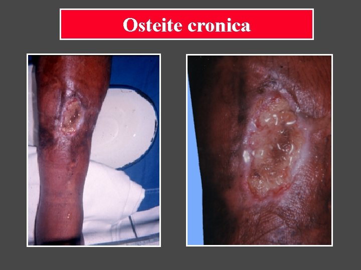 Osteite cronica 
