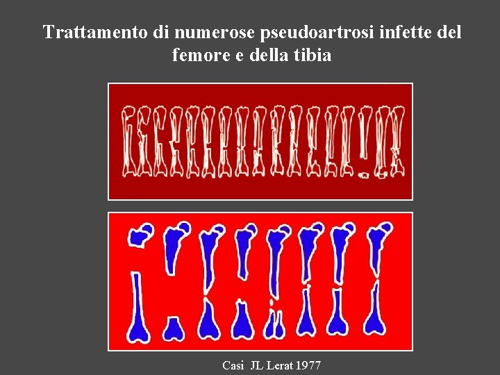 Trattamento di numerose pseudoartrosi infette del femore e della tibia Casi JL Lerat 1977