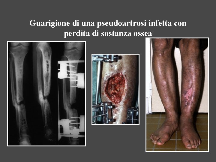 Guarigione di una pseudoartrosi infetta con perdita di sostanza ossea 
