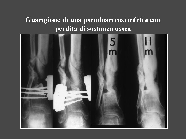 Guarigione di una pseudoartrosi infetta con perdita di sostanza ossea 