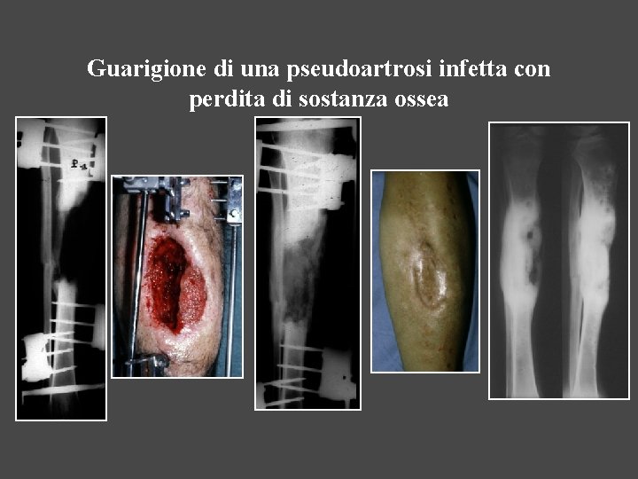 Guarigione di una pseudoartrosi infetta con perdita di sostanza ossea 